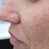 Image 1: Revitalize Your Skin with IPL Photofacial Treatments