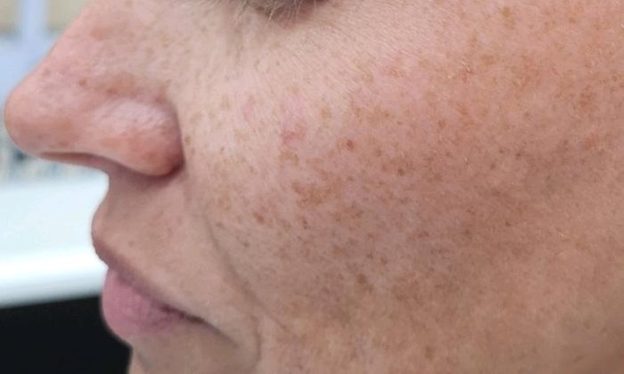 Revitalize Your Skin with IPL Photofacial Treatments