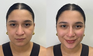 1 o 3 sesiones de mesoterapia facial inyectada