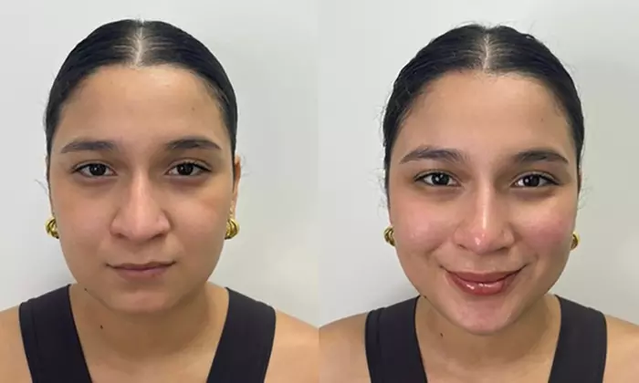 1 o 3 sesiones de mesoterapia facial inyectada