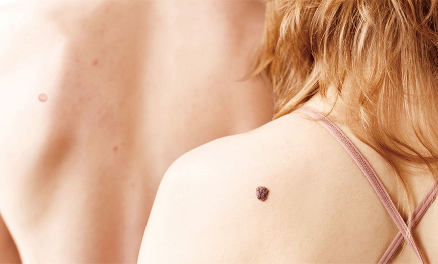 Image 2: Two-in-One Skin Tag Removal Kit