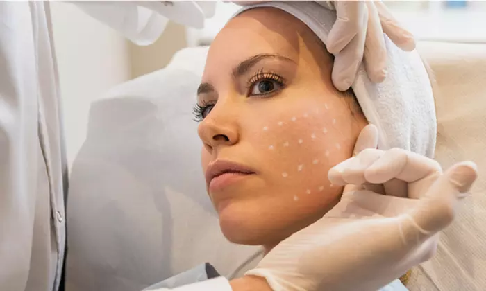Sesión mesoterapia facial y peeling en el centro República Argentina