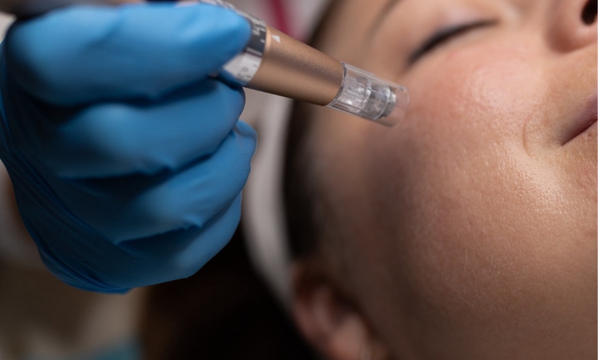 Image 2: Microneedling / Mikrodermabrasion