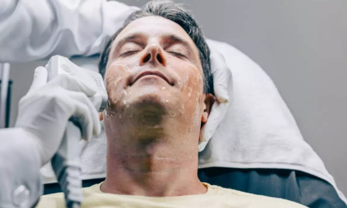 Sesión de tratamiento HIFU facial en una zona o rostro completo