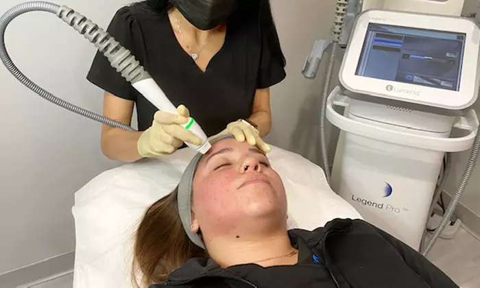 One RF MicroNeedling for Smoother Skin and Enhanced Collagen
