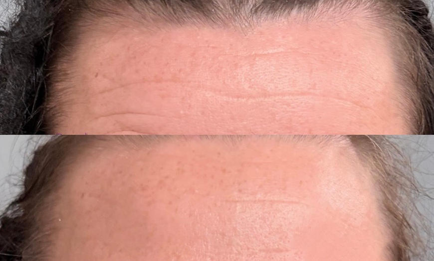 Image 5: One, Three, or Five Sessions of 60-Minutes Micro-Needling Treatment