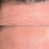 Image 5: One, Three, or Five Sessions of 60-Minutes Micro-Needling Treatment