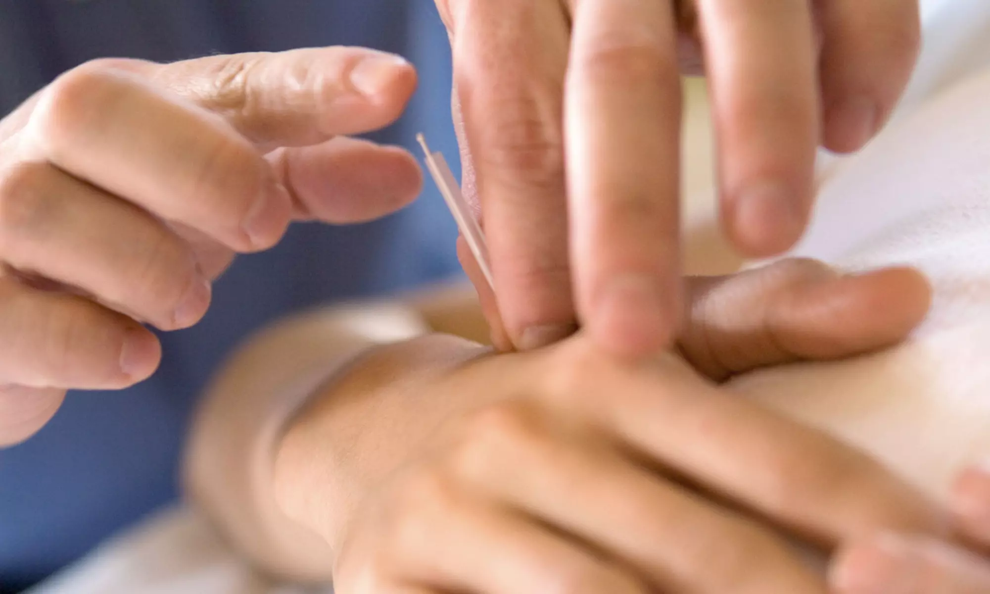 $49 for an Acupuncture Treatment at Chiropractic Health Group ($175 Value) - Primary Image