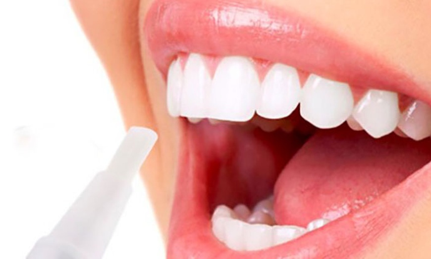 Image 5: Up to 62% Off on Teeth Whitening - Home Tray / Pen at Brighten Up Dental Clinic