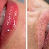 Image 2: Get One or Three Sessions of Hydra Gloss Lips with Hydrapen