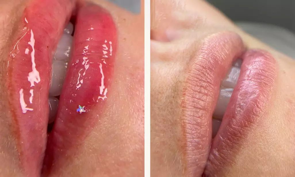 Get One or Three Sessions of Hydra Gloss Lips with Hydrapen