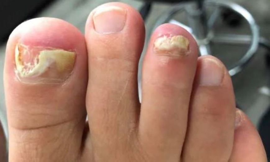 Image 1: Laser Toe Fungus Treatment