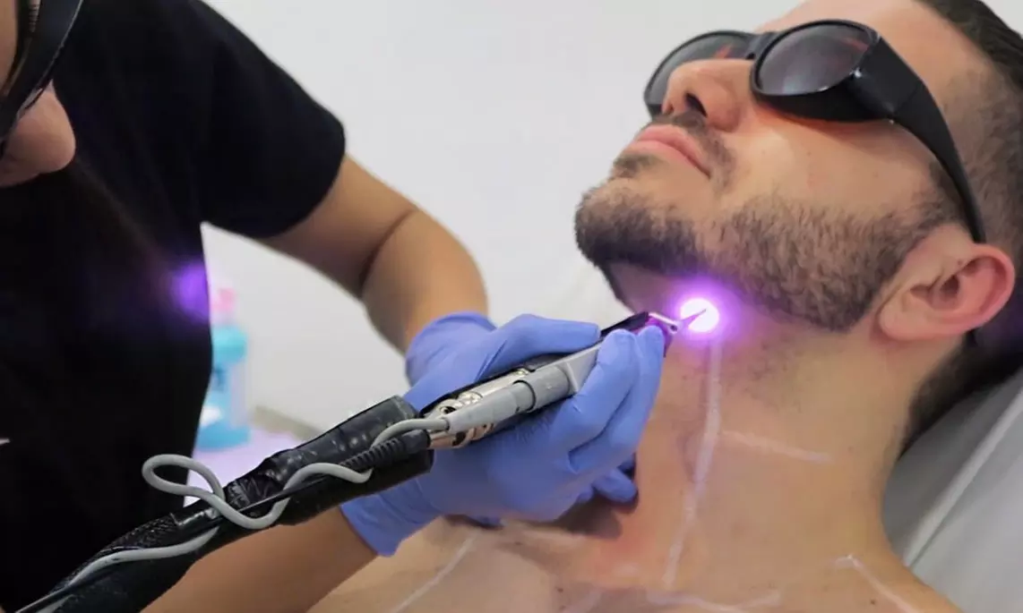 Six Laser Hair-Removal Treatments at Cambridge Laser Studio (Up to 87% Off) - Second Medium