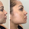 Image 1: Kybella Injections to Help Eliminate Double Chin Fat 