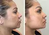 1 or 2 Vials of Kybella for Chin Fat Reduction at TrueBeauty Up To  65% Off