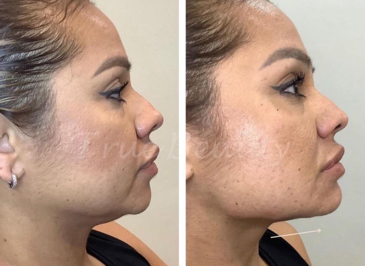 Kybella Injections to Help Eliminate Double Chin Fat