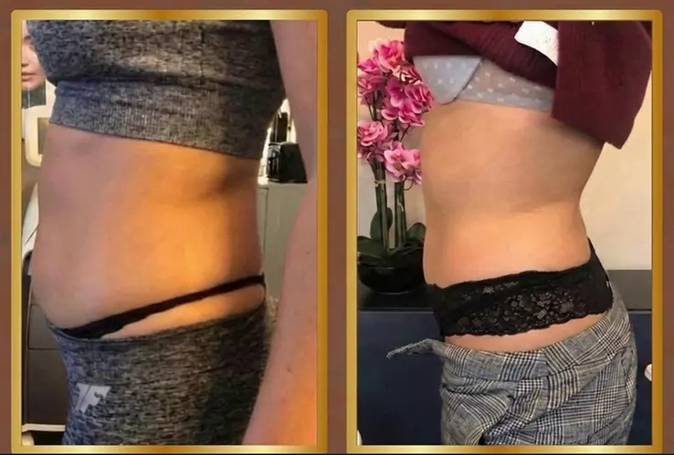 One, Three or Six Cavitation Bum Lift Experience or Cavitation Tummy Slim and Tone 360 Sessions (Up to 52% Off) - Second Medium