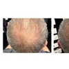 Image 6: Fuller & Healthier Scalp: 2, 4, or 6 Procell Hair Restoration Sessions