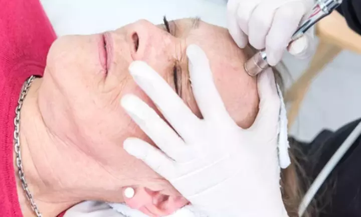 Radiofrecuencia facial Indiba y exfoliación con punta de diamante