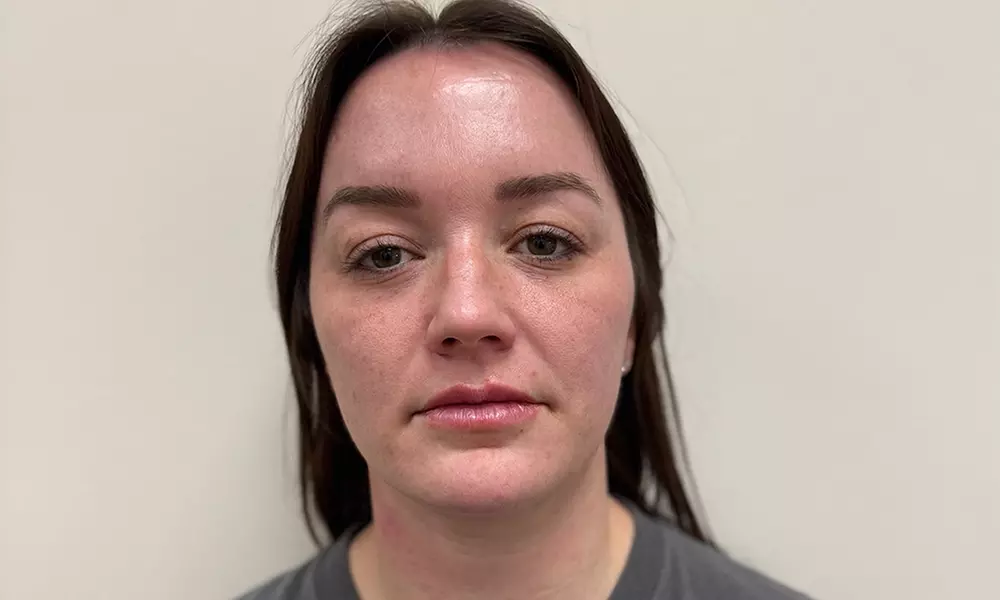 Enhance Your Lips with Half or Full Syringe Lip Filler (Up to 50% Off) - Second Medium