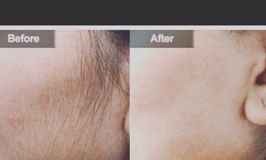 Image 3: Laser hair removal sessions at The MM Laser Clinic