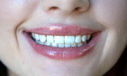 Wybielanie zębów lampą LED – standard - Smile room