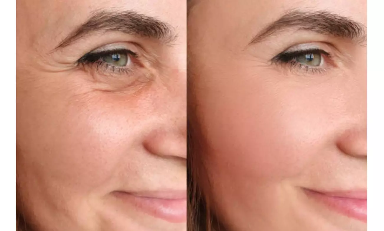 Tratamiento reafirmante inyectado en una zona a elegir para 1 persona