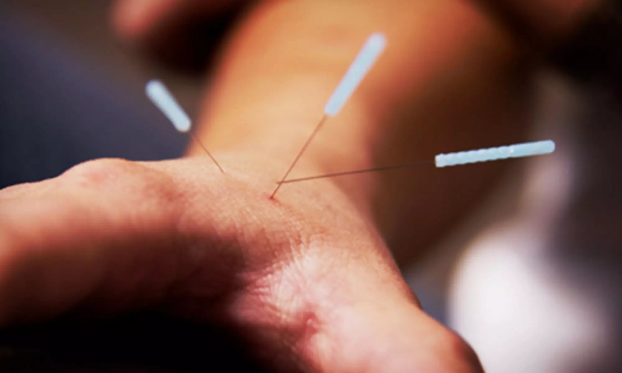 One, Three, or Six Community-Acupuncture Sessions at Acupuncture Together of Austin (Up to 55% Off) - Primary Image