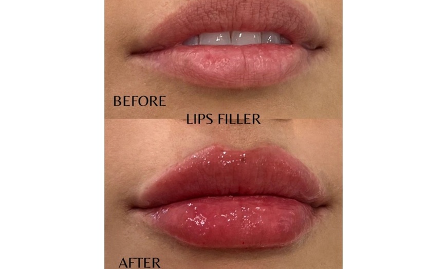 Image 10: One Syringe of Revanesse Versa for Lips or Face at Milan Medical