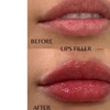 Image 10: One Syringe of Revanesse Versa for Lips or Face at Milan Medical