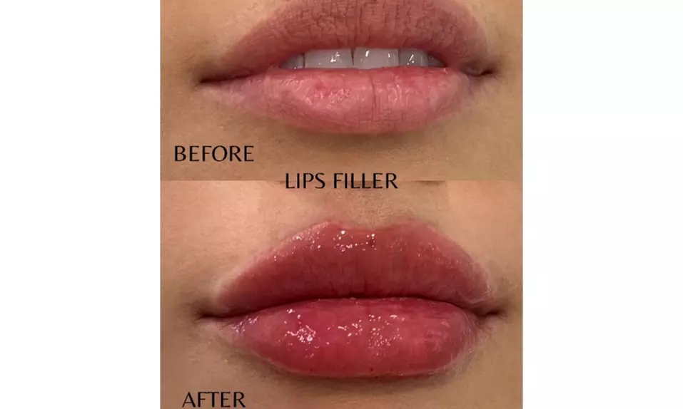 One Syringe of Revanesse Versa for Lips or Face at Milan Medical
