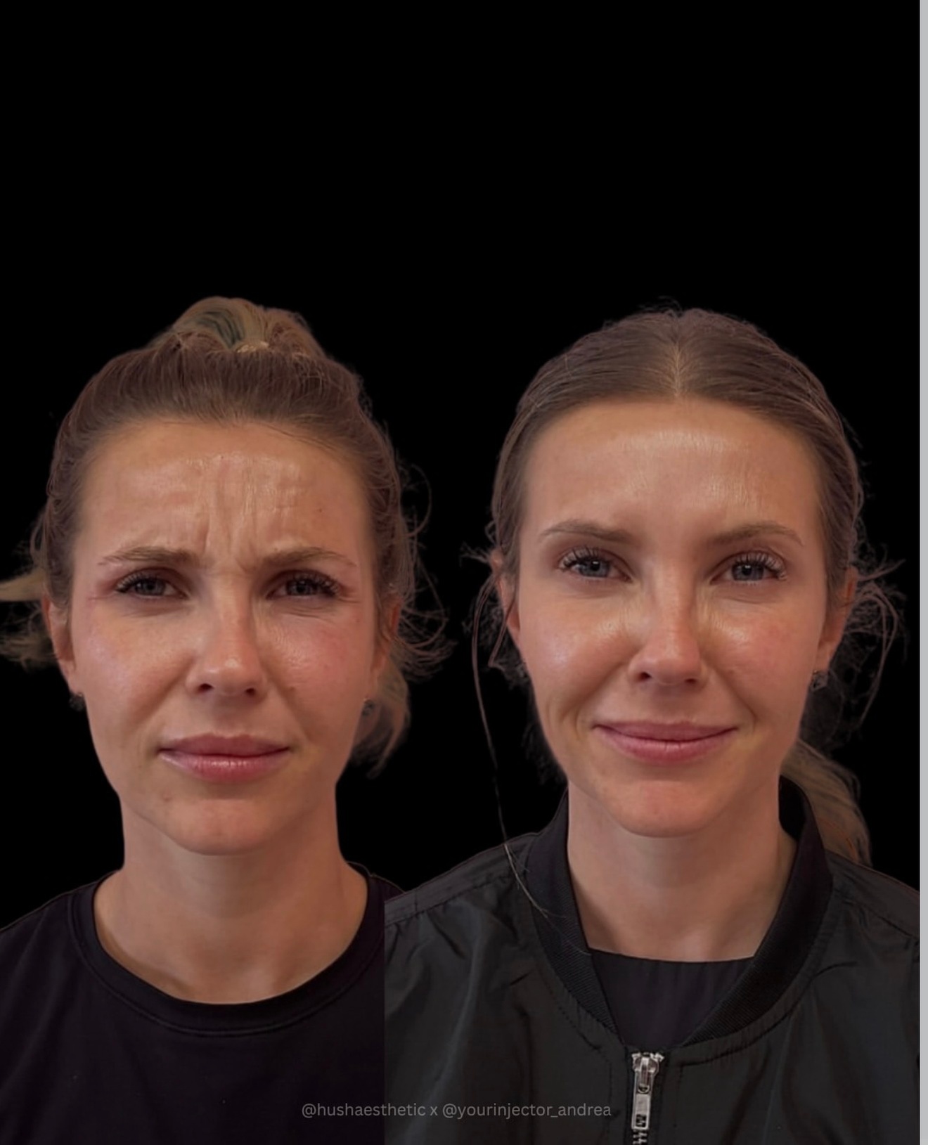 Up to 45% Off on Injectables at Hush Aesthetics, LLC