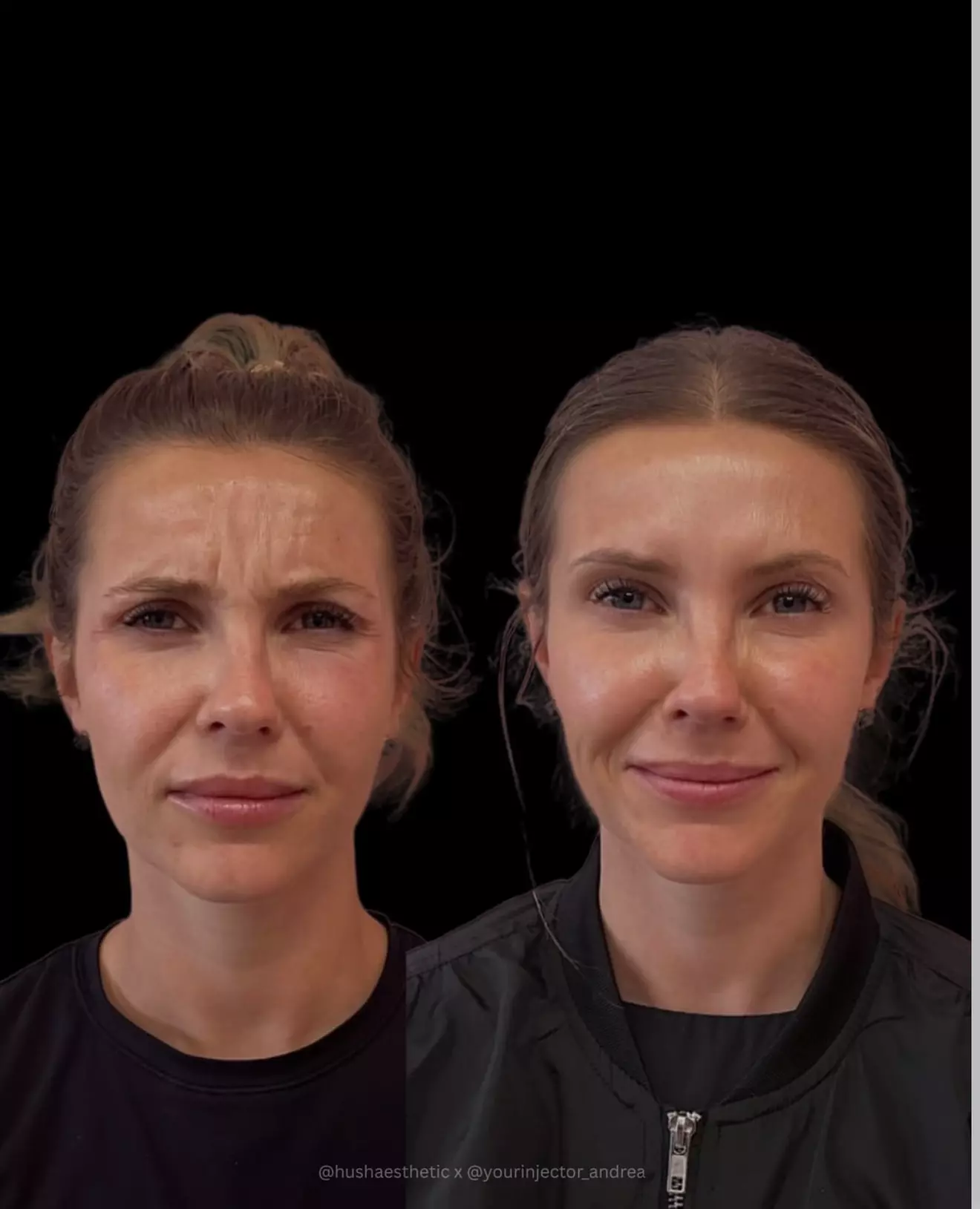 Up to 45% Off on Injection-Other-Dysport, Xeomin at Hush Aesthetics, LLC