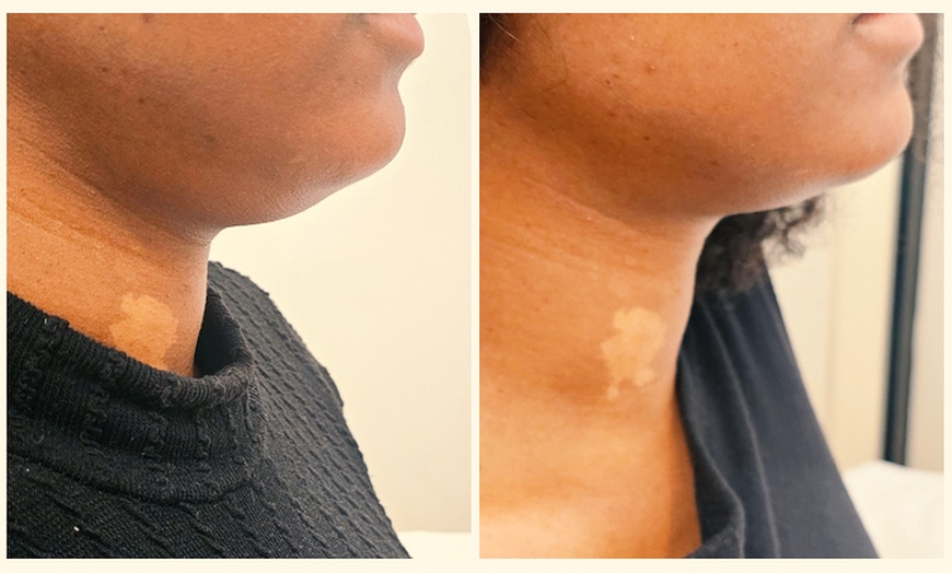 Image 2: Targeted Fat Reduction with One or Two Vials of Kybella