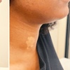 Image 2: Targeted Fat Reduction with One or Two Vials of Kybella
