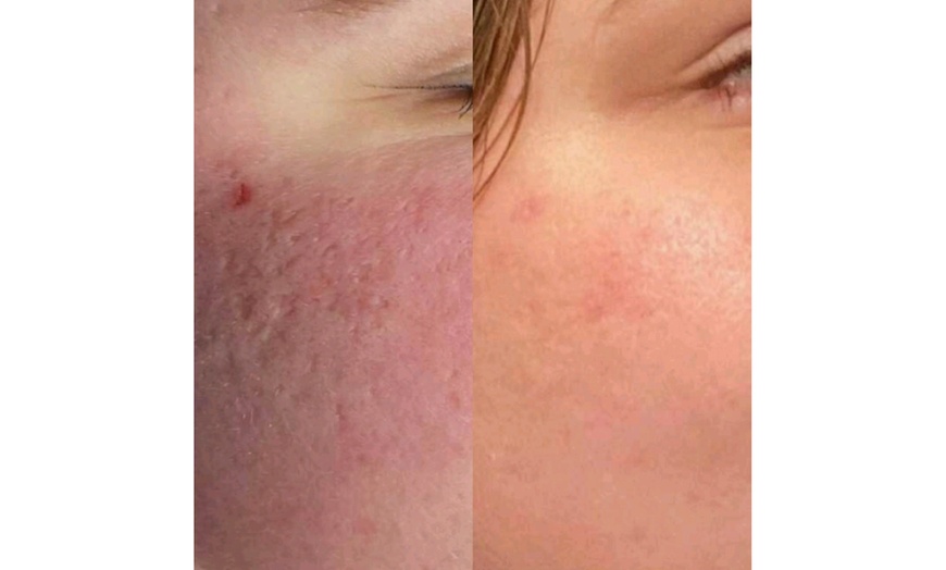 Image 2: 60 Min. Klassische Gesichtsbehandlung / Microneedling für 1 Person