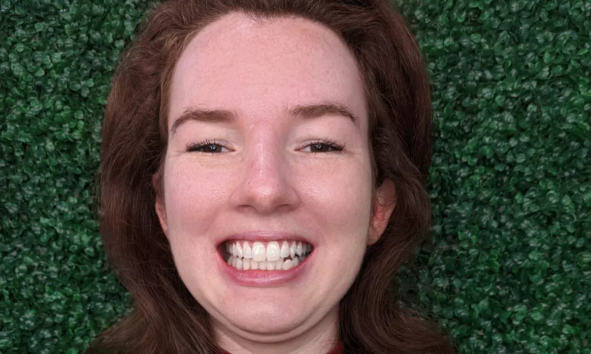 Premium 60-Minute Teeth Whitening at Smile Labs Penrith