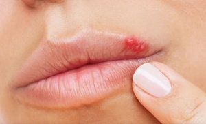 Consultation + Cold Sore & Genital Herpes Prevention - Valacyclovir