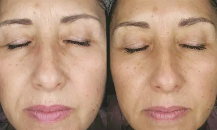 Endermologie LPG Body:  1, 2, or 3 45-Min Sessions For Perfect Sculpt