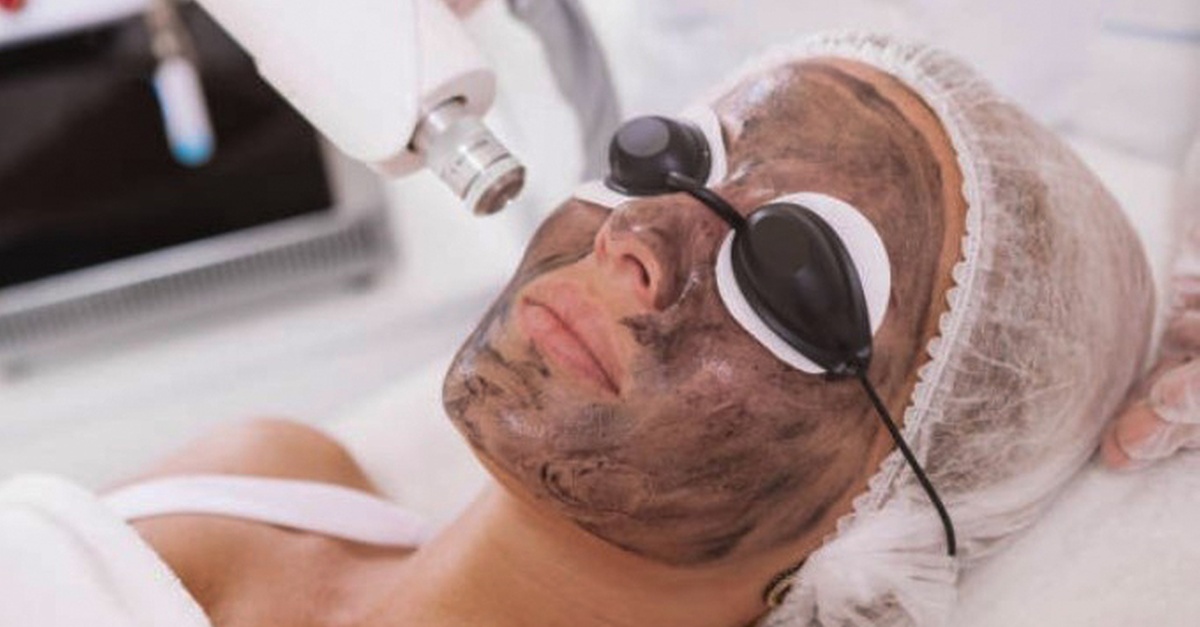 Tratamiento facial Hollywood Peel con carbón en Madrid