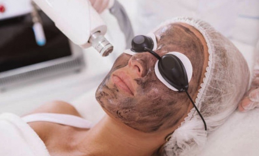 Image 1: Tratamiento facial Hollywood Peel con carbón y/o principio activo