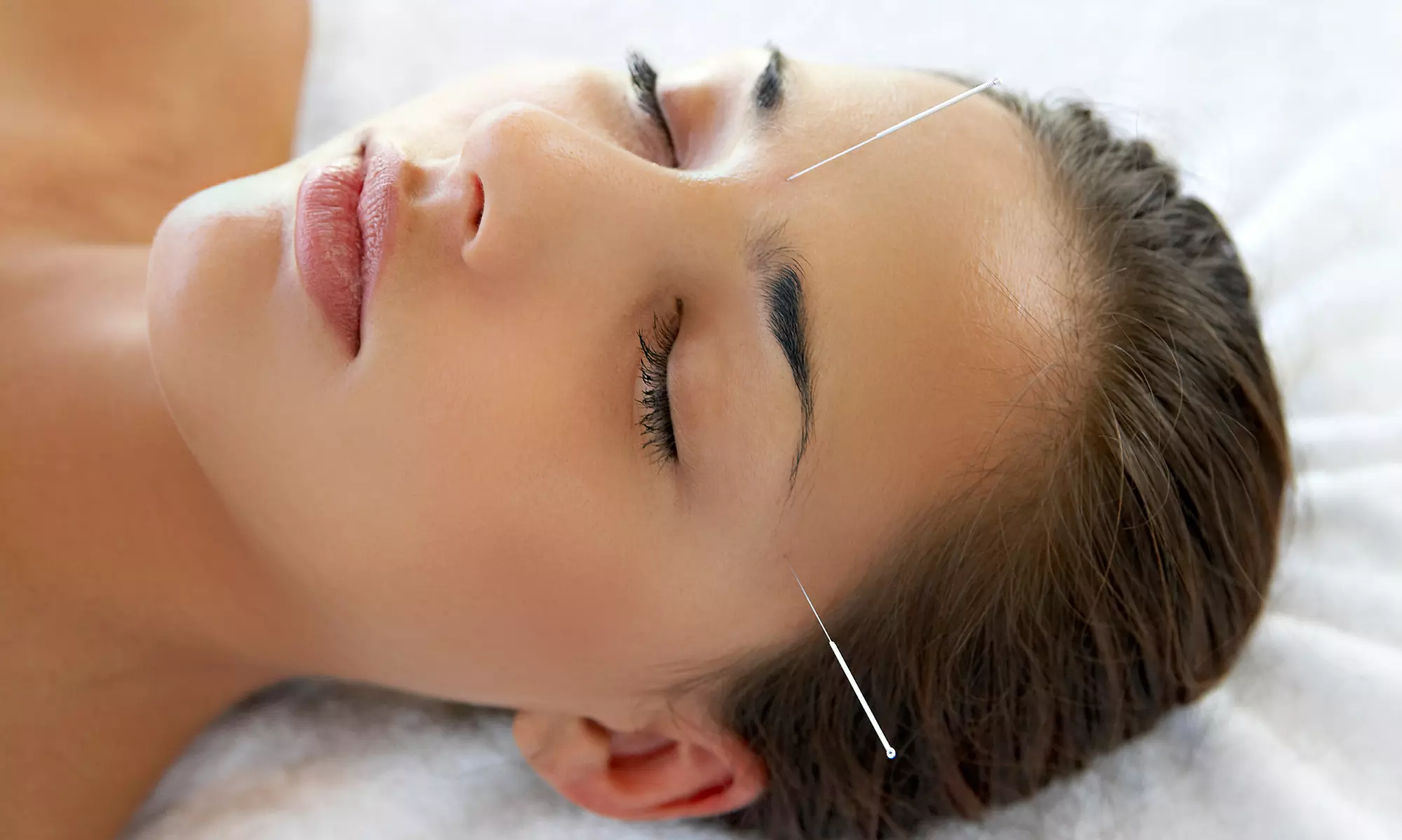 One or Two Acupuncture Treatments with Consultation at Acupuncture Laguna (Up to 60% Off) - Primary Image
