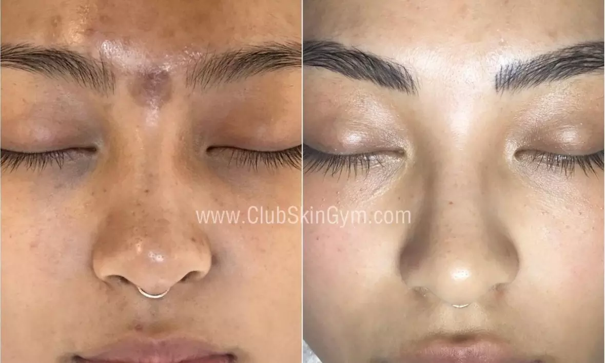 Up to 56% Off on Skin Treatment at Club Skin Gym - Primary Image