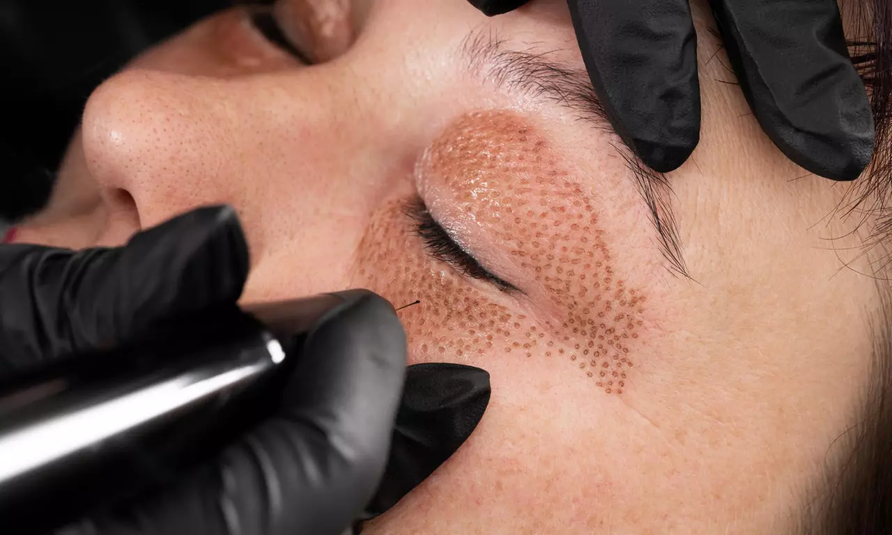 $199 for Fibroblast Plasma Pen Treatment for One Area at Advanced Aesthetics Academy ($350 Value) - Primary Image