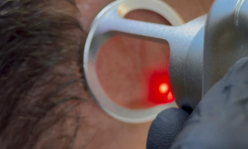 Image 5: 1 o 3 sesiones de rejuvenecimiento facial con láser ‎revitalizante