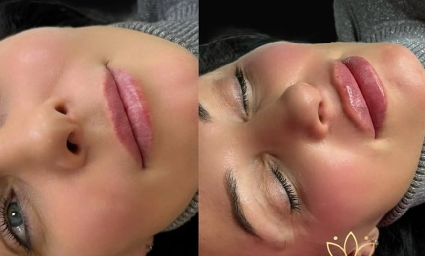 Image 7: Get a Dermal Filler Today: 1ml or 2ml Lips