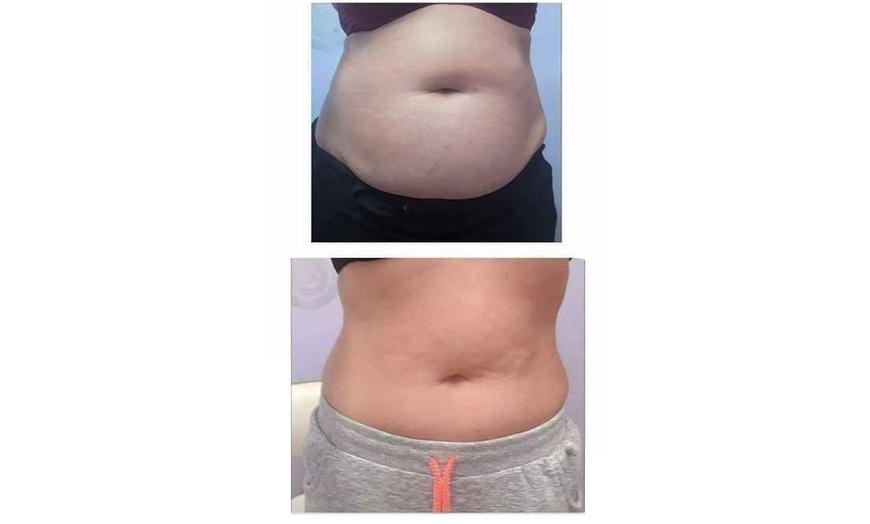 Image 6: Fat Freezing with Complimentary Meal Plan at Liposuction Belfast