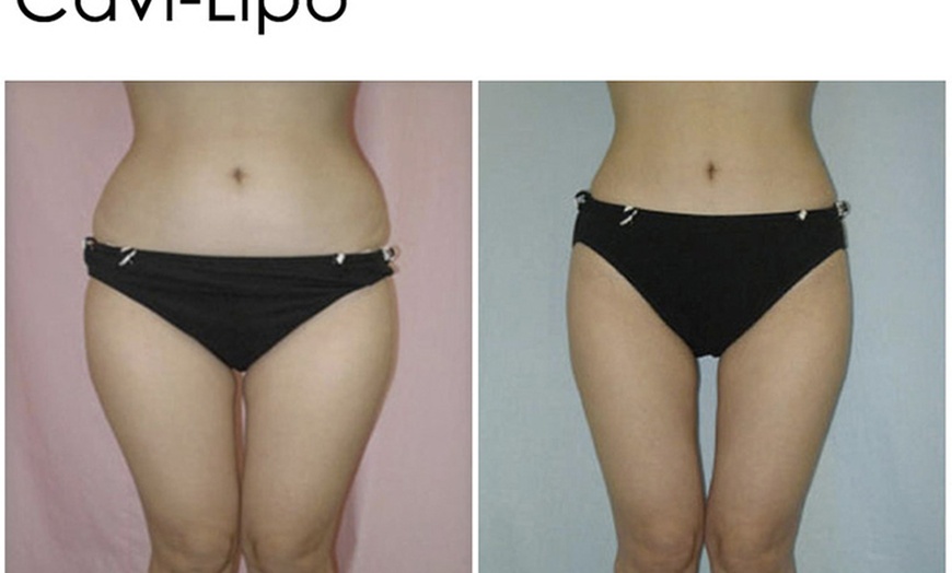Image 2: One or Two Cavi-Lipo Fat Loss Treatments
