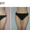 Image 2: One or Two Cavi-Lipo Fat Loss Treatments