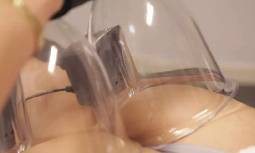 Brazilian Butt Lift in Den Haag